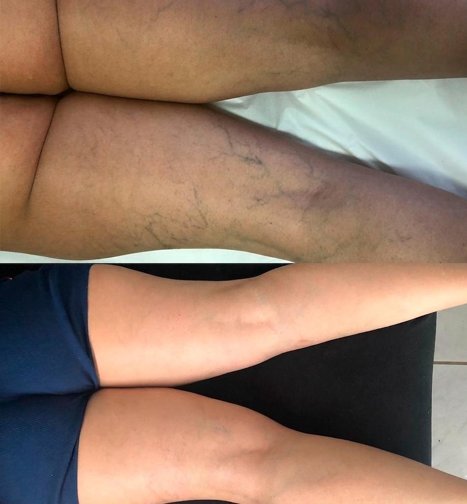 Escleroterapia Premium